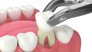 راهنمای کامل مراقبت‌های پس از کشیدن دندان