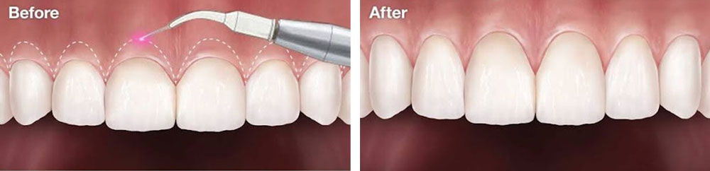 جراحی لثه دندان‌پزشکی دنتریتا