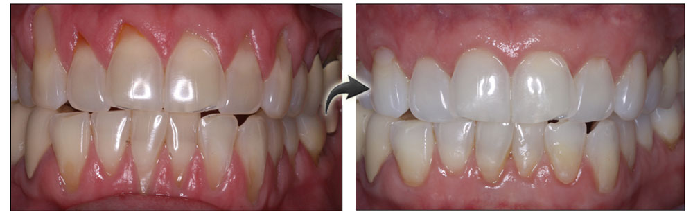 جراحی لثه دندان‌پزشکی دنتریتا