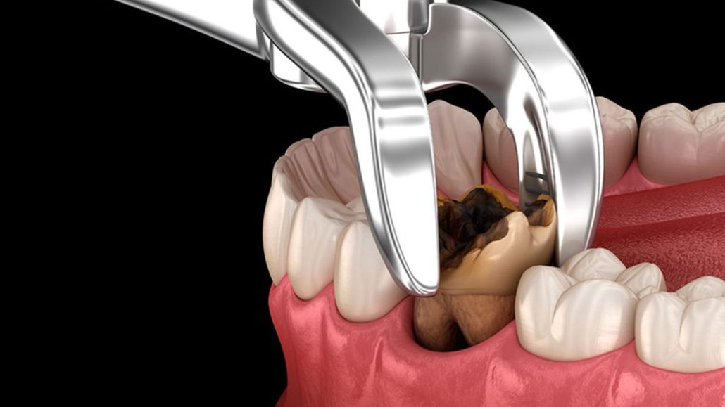معمولاً ۳ تا ۴ روز پس از کشیدن دندان، بخصوص اگر بیش از یک دندان کشیده شده باشد، درد و ناراحتی کاهش می‌یابد.