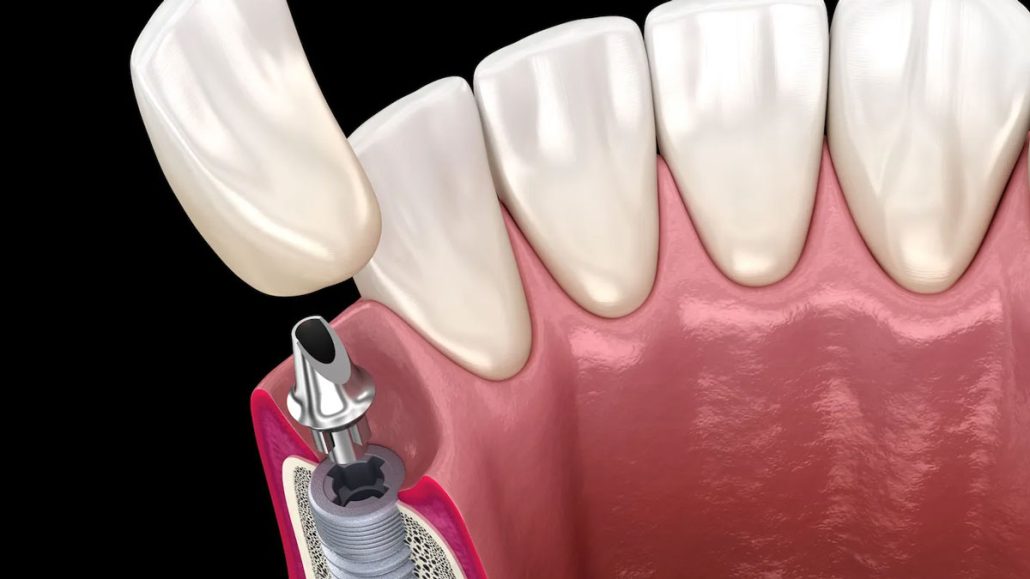 یک پایه سازگار با بدن (ایمپلنت) در استخوان فک قرار گرفته و پس از اطمینان از جوش خوردن آن با استخوان، روکش نهایی روی آن نصب می‌شود.