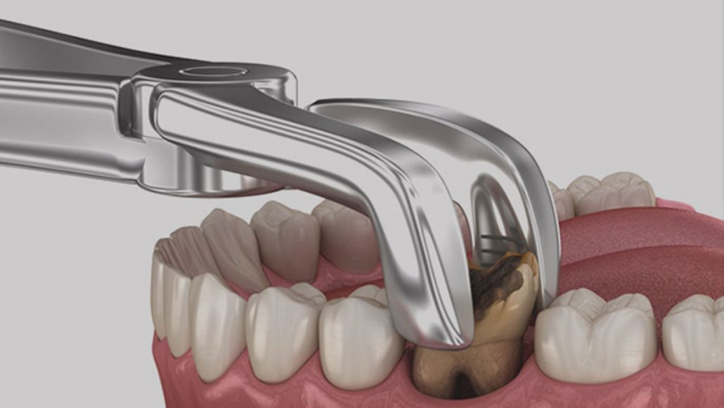 پس از کشیدن دندان، رعایت دستورالعمل‌های مراقبتی برای کنترل خونریزی و کمک به تشکیل لخته خون در حفره دندان بسیار مهم است.