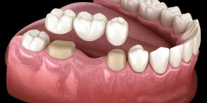 دندانپزشکی دنتریتا راهنمای جامع مراقبت‌های پس از جراحی دهان (کشیدن دندان، لثه و ایمپلنت)