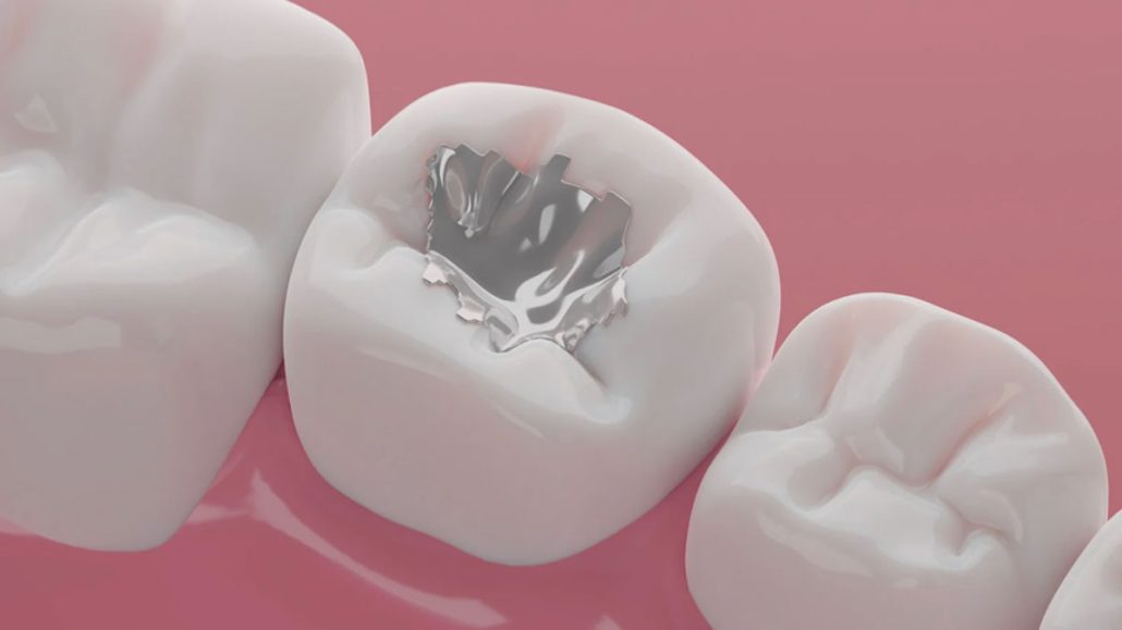 اکیداً توصیه می‌شود تا زمان برطرف شدن کامل اثر بی‌حسی، از جویدن هرگونه غذا خودداری فرمایید.