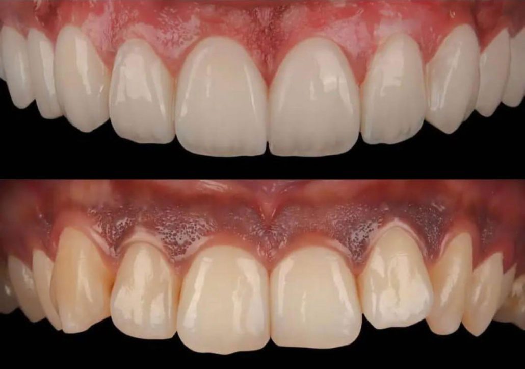 تصویر قبل و بعد از ونیر - کلینیک دندانپزشکی دنتریتا