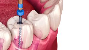 راهنمای کامل مراقبت‌های پس از درمان ریشه (عصب‌کشی)